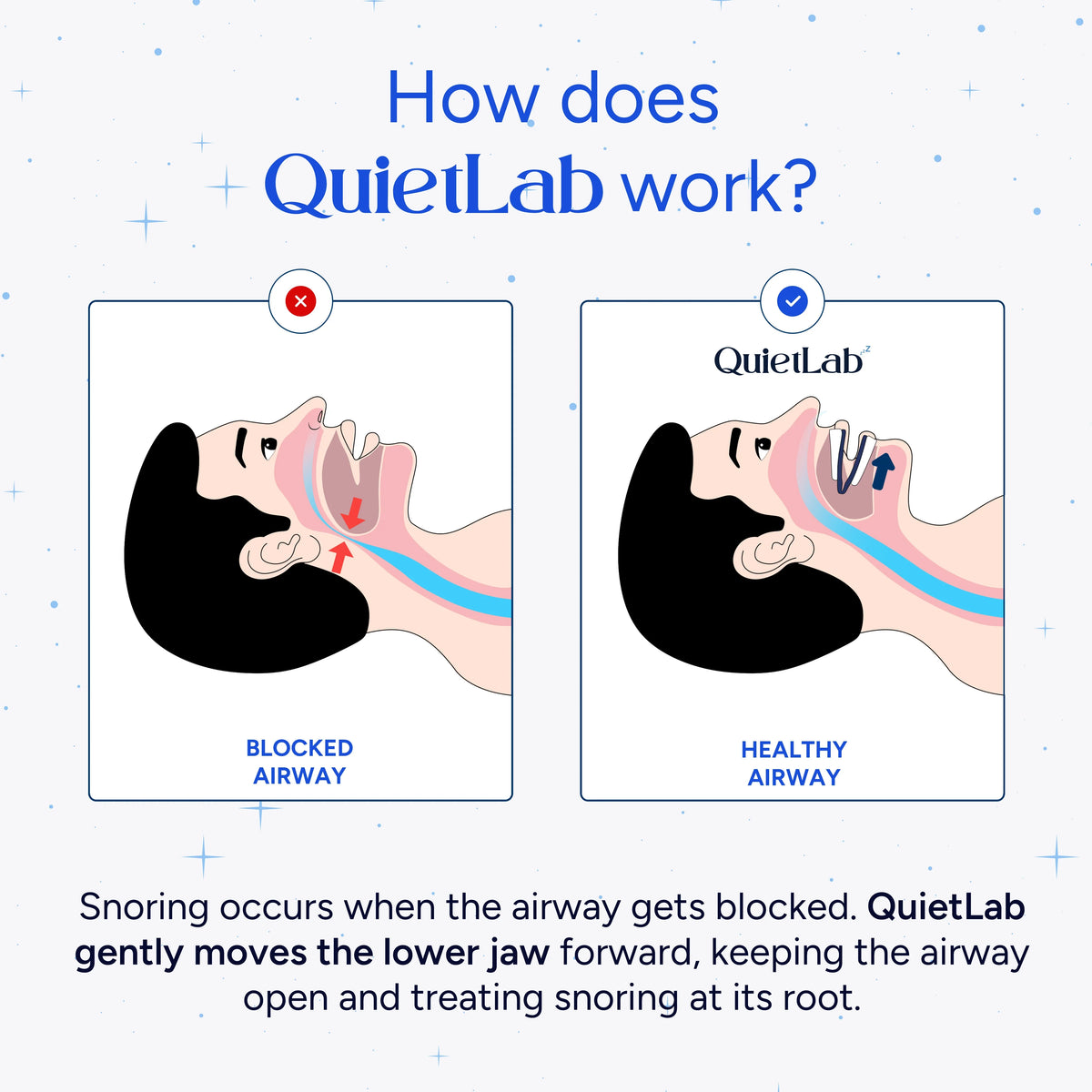 QuietLab Pro® Adjustable Anti-Snoring Mouthpiece